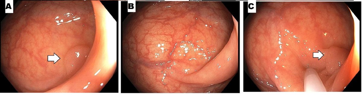 Tips and tricks to make resection &amp; retrieval of small polyps quick and seamless! ow.ly/z1tM50HBQ52