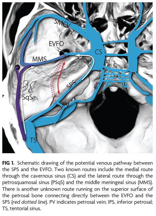 "Petrobasal Vein: A Previously Unrecognized Vein Directly Connecting the Superior Petrosal Sinus with the Emissary Vein of the Foramen Ovale" #journalclub #radfellows #NeuroRad #NeuroTwitter <a href="/SNISinfo/">SNIS Info</a> |  bit.ly/3u7jloR
