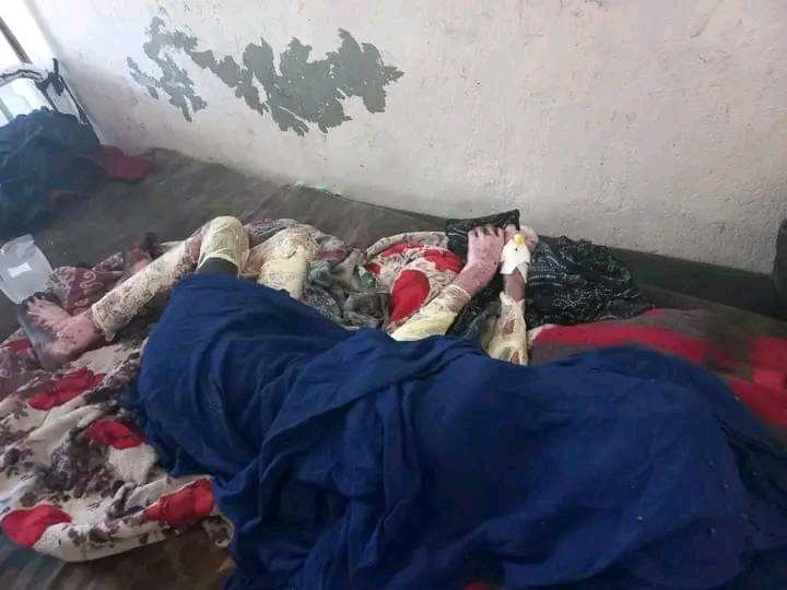 lahadda88's tweet image. #Afar children that survived from heavy artillery launching by #TPLFTerroristGroup in #Abala #harramali kebele,their body is burned. now this 2 brother are taking treatment in #Dubti hospital. #Afargenocide #AfarUnderAttack 
@kontiem @AfarWatch @miniliksalsawi @iyoba4u @HermelaTV