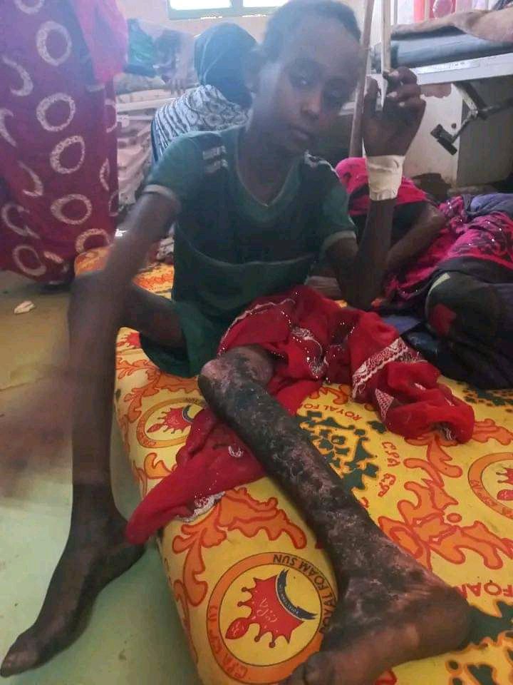 lahadda88's tweet image. #Afar children that survived from heavy artillery launching by #TPLFTerroristGroup in #Abala #harramali kebele,their body is burned. now this 2 brother are taking treatment in #Dubti hospital. #Afargenocide #AfarUnderAttack 
@kontiem @AfarWatch @miniliksalsawi @iyoba4u @HermelaTV