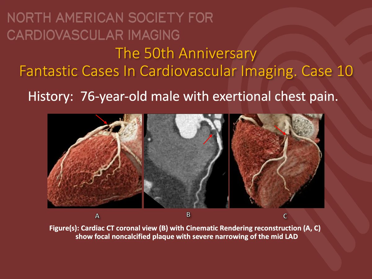 #NASCI 50th Anniversary Case Series 

Case 10 
Courtesy of Abdullah Al Khalifah, <a href="/CardiacRad/">Stefan Zimmerman</a>, et al Johns Hopkins Medicine–Dept Radiol <a href="/Hopkins_Rad/">Johns Hopkins Radiology</a>

What is the right answer?! 

#YesCCT <a href="/GregKicska/">Gregory Kicska</a> <a href="/JRevRad1/">Jonathan Revels DO, FSAR</a> <a href="/DanielVargasMD/">Daniel Vargas, MD</a> <a href="/kirschj/">Jacobo Kirsch, MD, MBA, FACR</a> <a href="/prachipagarwal/">Prachi Agarwal</a> <a href="/AwsHamid5/">Aws Hamid, MD, MS</a> <a href="/DeCeccoCN/">Carlo N. De Cecco, MD, PhD</a>