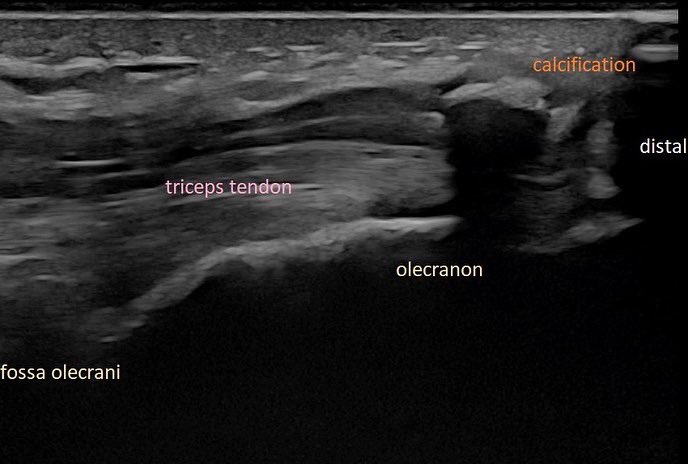 SportklinikBern's tweet photo. #insertiontendinitis #tricepsbrachii with calcification - the mri was inconclusive and missed the calcification… #mskus #pocus #pocushub #logiqE10 #tendinitis https://t.co/J2o1RScK7e