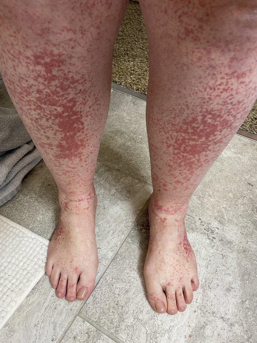 MyRobitaille's tweet photo. @DrMoIbrahim I was diagnosed with Vasculitis a year ago, but no one could help with a cure. I still live in pain and flare ups. Is there a way to treat?! https://t.co/VlR50JryCQ