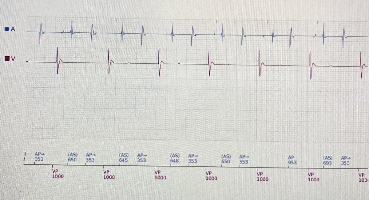 #EPfellows #cardiologyfellows what’s the problem with this presenting EGM and how would you fix?