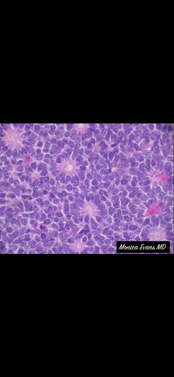 JMGardnerMD's tweet photo. Eye tumor from a baby. Entire globe of eye cut in half front to back. Amazing pics by Dr. Monica Evans. Your diagnosis? Reply then click the link to check your answer https://t.co/KB8IE1i8ma #pathologists #pathology #pathTwitter #ophthalmology #ophtho #eyepath https://t.co/iNRSoLWxas