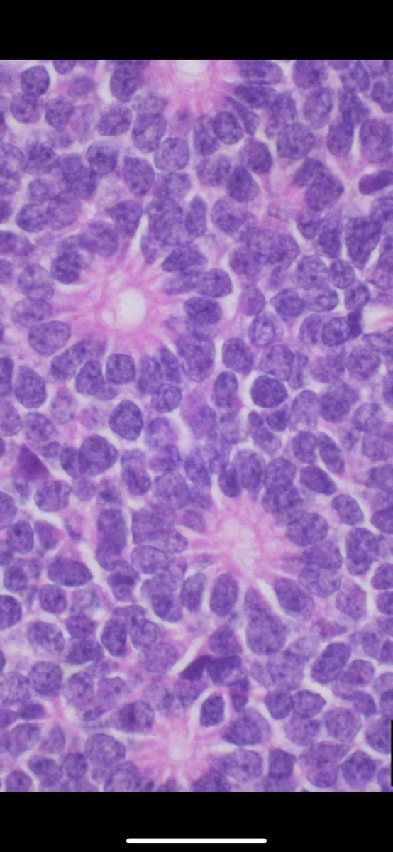 JMGardnerMD's tweet photo. Eye tumor from a baby. Entire globe of eye cut in half front to back. Amazing pics by Dr. Monica Evans. Your diagnosis? Reply then click the link to check your answer https://t.co/KB8IE1i8ma #pathologists #pathology #pathTwitter #ophthalmology #ophtho #eyepath https://t.co/iNRSoLWxas