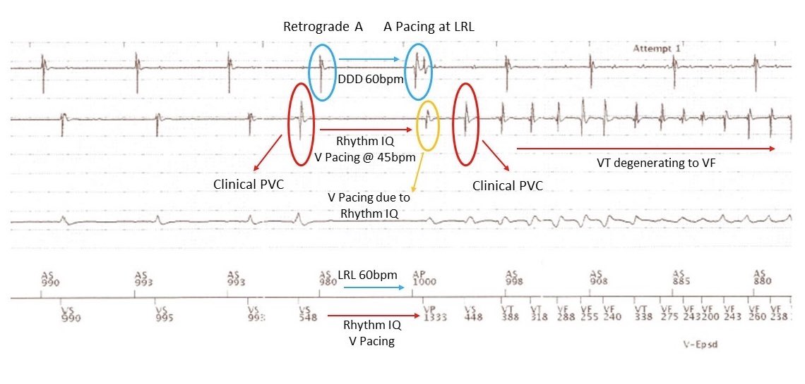 KeepInRhythm's tweet image. Timing is everything! PVC throwing off algorithmic attempt to minimize VP, causing long-short sequence and landing in the dangerous zone of repol of a VP=the perfect storm! Should we set faster LRL on pts with PVCs to avoid long-shorts? #epeeps @EricaZado @Ariat104 @narrowQRS