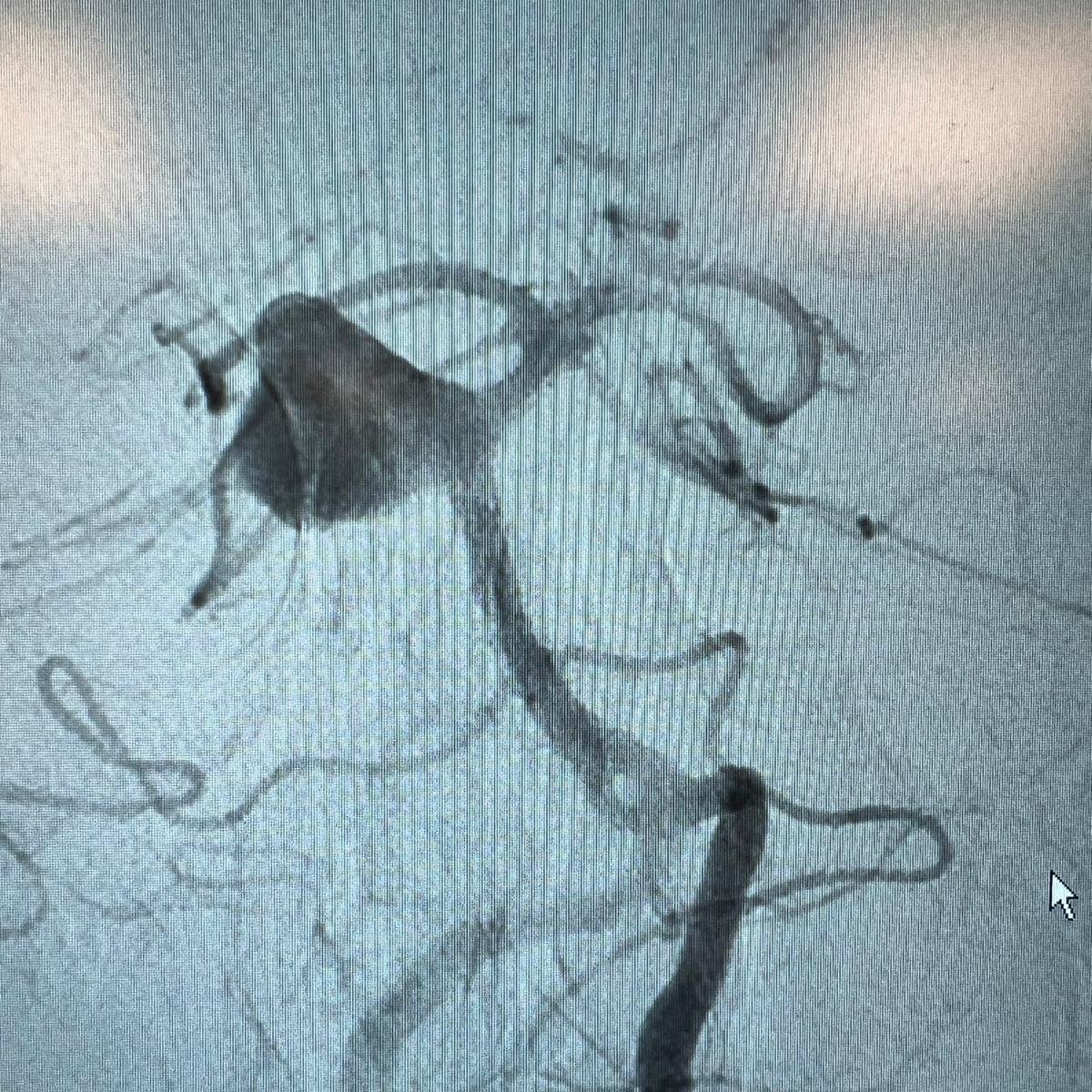 Rapid Medical (@rapid__medical) on Twitter photo Learn how <a href="/MohsenNouriMD/">Mohsen Nouri</a> at Jamaica Hospital, NY leveraged the benefits of #Comaneci to treat a ruptured aneurysm:
“I liked the visibility, navigability, and re-sheathability! Also, the fact that we could deploy it through a balloon gave security to act on time if needed”. Learn how <a href="/MohsenNouriMD/">Mohsen Nouri</a> at Jamaica Hospital, NY leveraged the benefits of #Comaneci to treat a ruptured aneurysm:
“I liked the visibility, navigability, and re-sheathability! Also, the fact that we could deploy it through a balloon gave security to act on time if needed”.