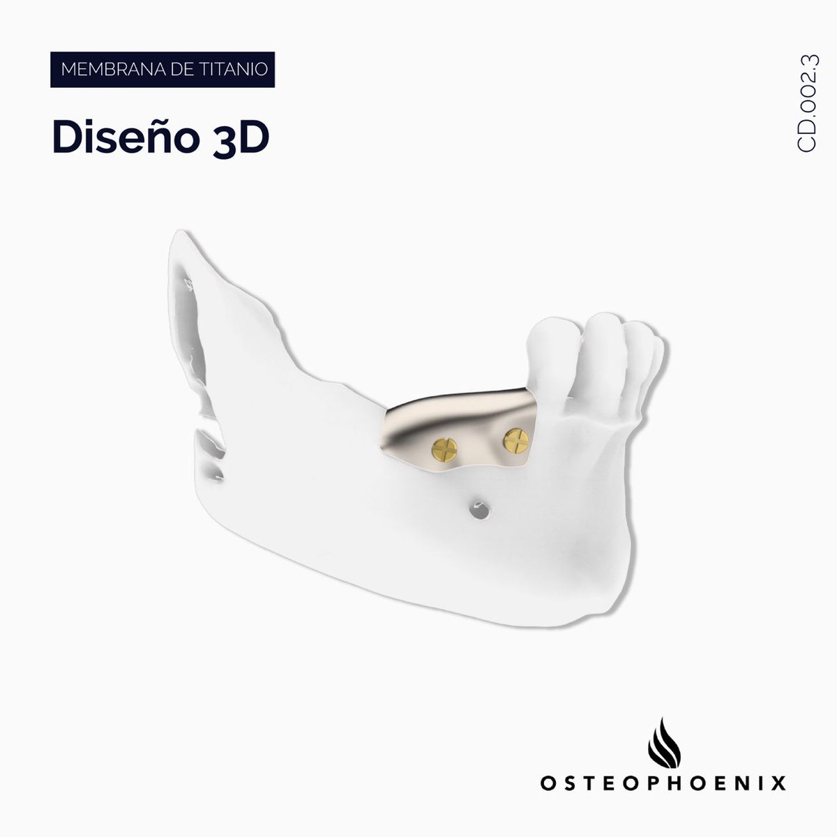 OsteophoenixSL's tweet photo. Caso clínico con foil a medida en el que conseguimos obtener el hueso necesario para la colocación de implantes y con la formación de encía queratinizada. 
https://t.co/H9M1LpfpVv https://t.co/EE9mhC8shH