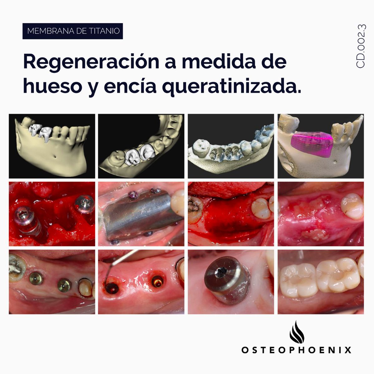OsteophoenixSL's tweet photo. Caso clínico con foil a medida en el que conseguimos obtener el hueso necesario para la colocación de implantes y con la formación de encía queratinizada. 
https://t.co/H9M1LpfpVv https://t.co/EE9mhC8shH