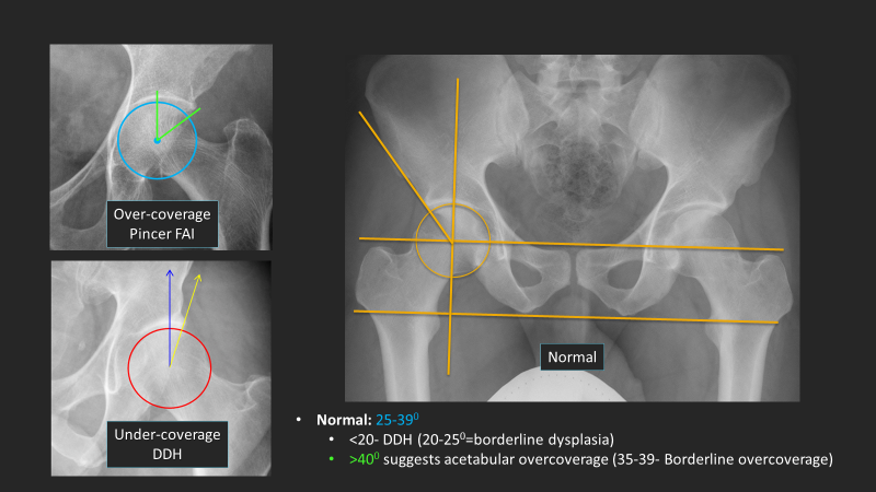 Normal versus DDH versus PINCER (superior overcoverage)- based on LCEA (lateral central edge angle)

Magic numbers: 

Normal: 25-39
Superior overcoverage (PINCER)- &gt;40
DDH: &lt; 20 
20-25- borderline dysplasia
