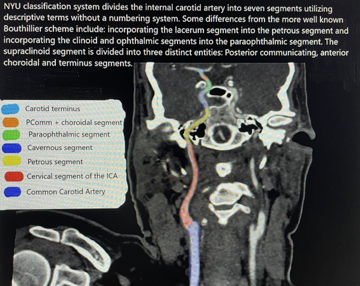 While there are many classification systems for ICA anatomy, the NYU classification seems to be more practical on cross sectional imaging and removes some confusion regarding the lacerum and clinoid segments. #radres #Neurorad #NeuroTwitter #Neurosurgery #MedEd #FOAMrad