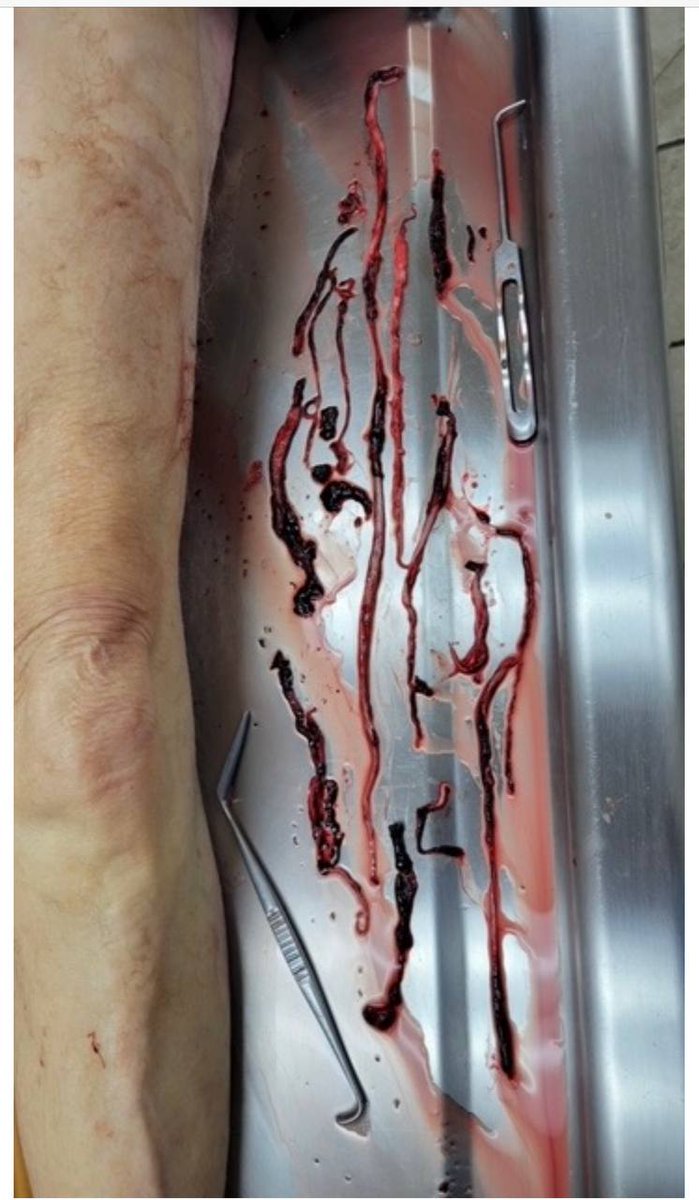 Yo_Ma7510's tweet photo. 🚨Richard Hirschman, directeur de pompes funèbres, a embaumé beaucoup de personnes mortes d'attaques cardiaques/cérébrales.
Il a trouvé leurs veines et artères remplies de caillots non naturels, avec d'étranges matériaux fibreux, remplissant complètement le système vasculaire🤮🤬 https://t.co/wByTvv9JTb