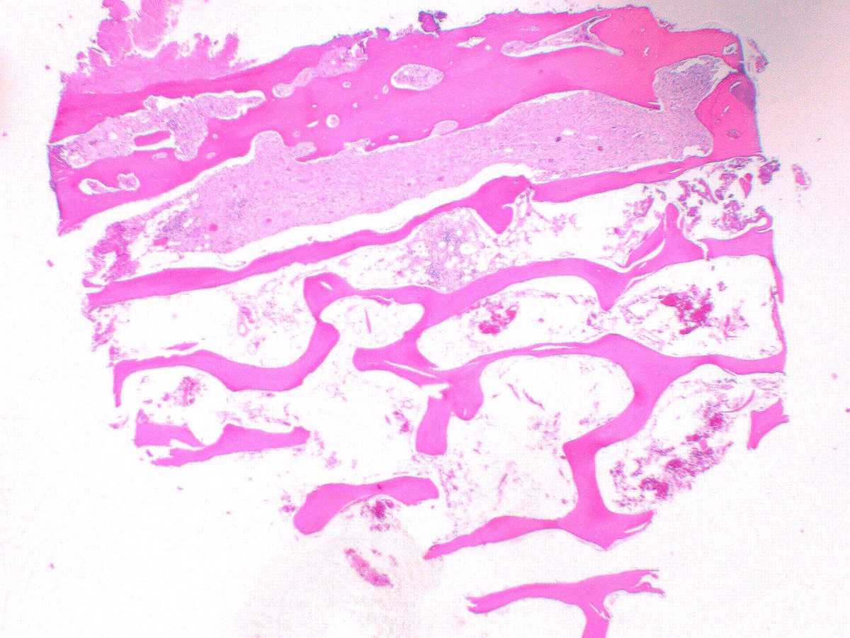 #BST 
 Sharing a case that requires 100% clinical radiological correlation for the diagnosis. 

I knew of the existence of this entity but I thought I would never see a real case until I got it! 

Male 60s with distal femur bx.