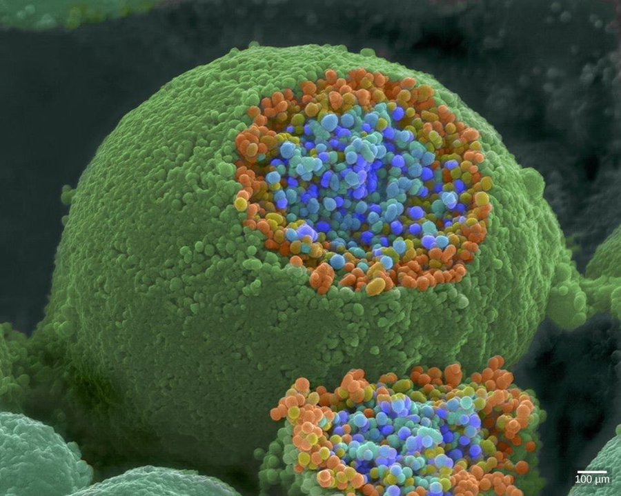 slava__bobrov's tweet photo. How a nerve ending looks. It has been broken open to reveal vesicles (orange and blue) containing chemicals used to pass messages in the nervous system: 

#neuroscience [by Tina Carvalho] https://t.co/dTBLEGTH7b