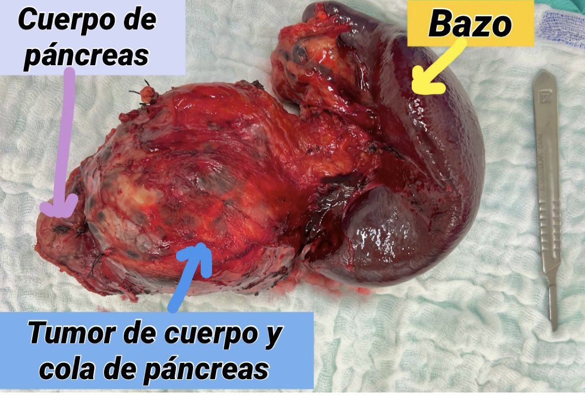 OmarChungata's tweet photo. Pancreatectomía corporocaudal + esplenectomía por tumor de cuerpo y cola de páncreas 
#tumordepancreas
#pancreatectomiacorporocaudal
#pancreatectomiadistal
#pancreatectomia 
#pancreatectomy
#pancreas
#cirugiadigestiva
#cirugiadealtacomplejidad https://t.co/uJT9WoztZf