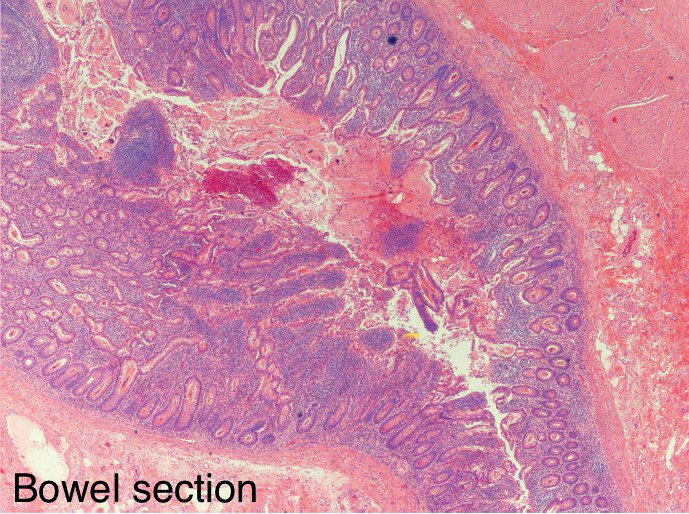 DrTravisBrown's tweet photo. Cystic fibrosis flash card
Autosomal recessive
Caucasian carrier ~1/20
Live births 1/2500
CFTR gene
Impaired ENaC (epith sodium channel)
⬆️Na in sweat
⬆️viscous mucus
Case 18 yr♂ileostomy reversal
Histo: inspissated mucus in GI tract
Ep 44 #ThisPathLife #podcast
#PathTwitter https://t.co/IbL7pBaKyu