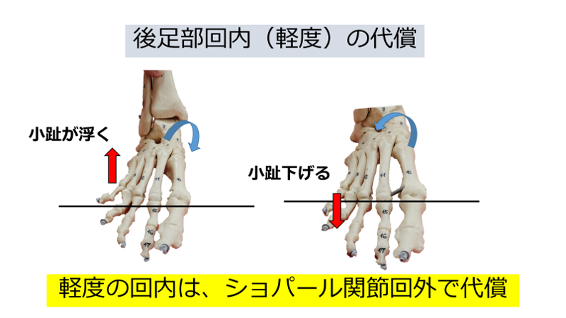 miya366494678's tweet photo. 足部のアライメント評価は難し印象がありますが、
母趾、小趾、踵が地面につくように代償する
と考えると分かりやすくなります
例えばショパール関節回外によって母趾が浮くと、
後足部回内または1列底屈によって浮いた母趾を下げます
このような視点で足部を見てみると、理解しやすく面白いですよ😁 https://t.co/SrMWVjdW0Z