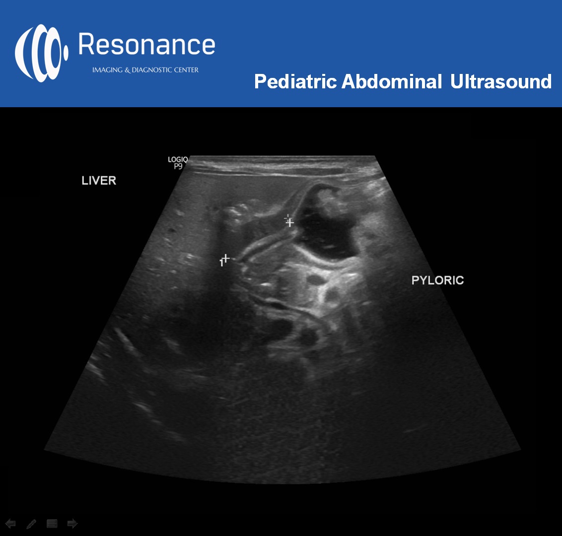 #pediatricabdominalultrasound is a #diagnosticimaging tool to scan the #abdominalorgans. It is a great #diagnostictool for #children because there is #noexposuretoradiation and there is usually no need for #sedation or #generalanesthesia. 

Read more: rb.gy/0vjknd
