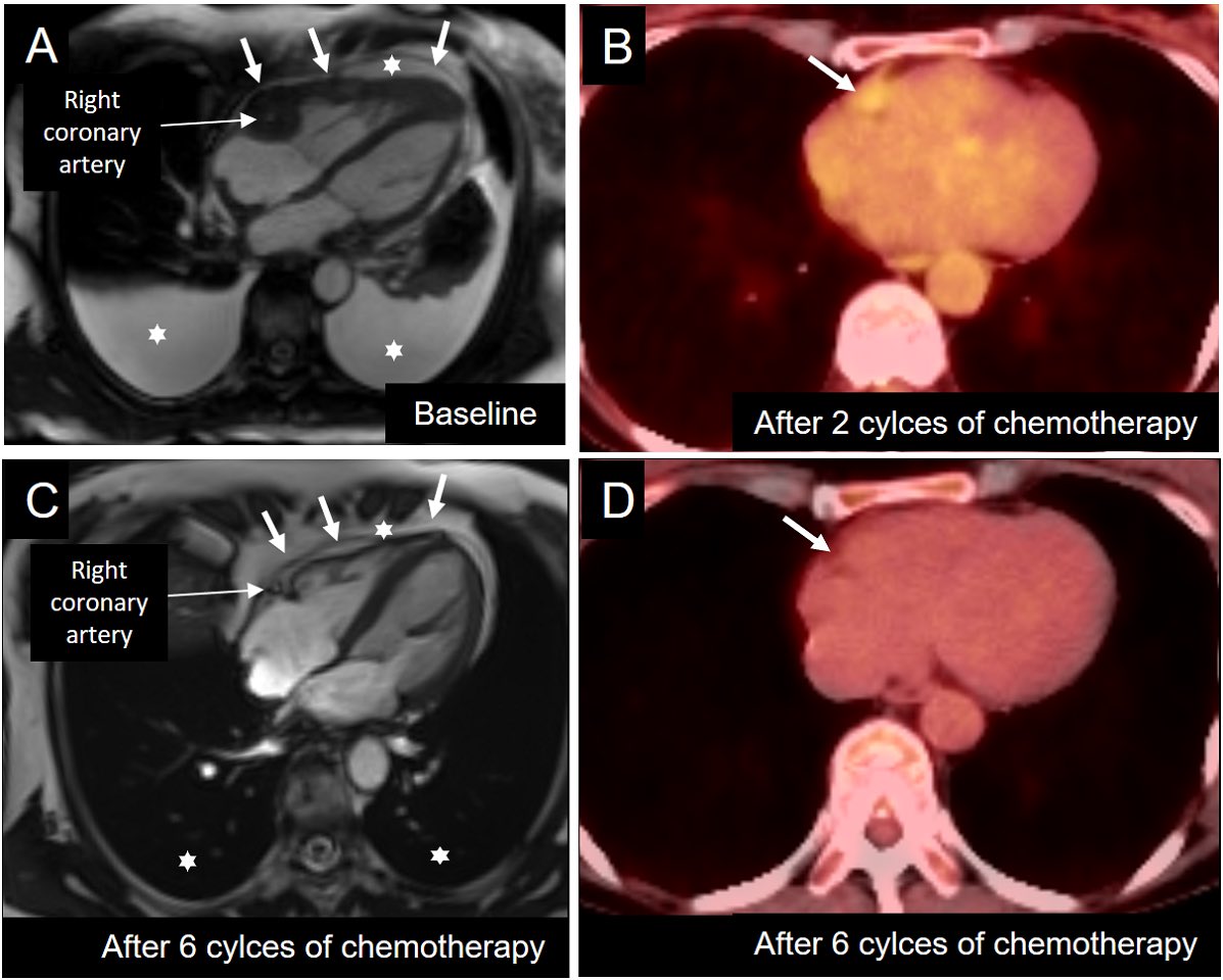 chrisgraeni's tweet photo. Check out our new case in #JNCjournal #JournalNC how multimodality imaging #whyCMR #cvNuc #ThinkPET can help diagnose cardiac B-cell #lymphoma and document treatment success.

https://t.co/ugxONHSC2k https://t.co/iNQ6mnLhvL