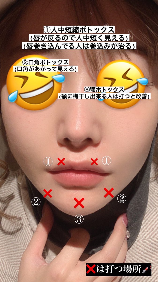 吉川ちえ 整形垢 明後日また人中ボトックス打ちに行く それと口角ボト と顎の梅干しシワボトックスもやろーっと Twitter