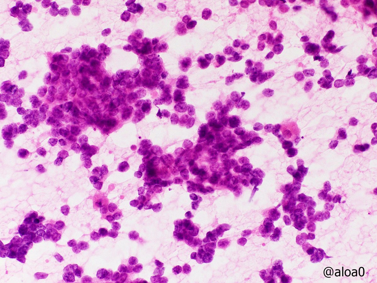 aloa0's tweet photo. Parotid gland mass. Cyto-histo correlation. #cytopath #ENTpath #HNpath 1/2 https://t.co/jKxwX2RZPD