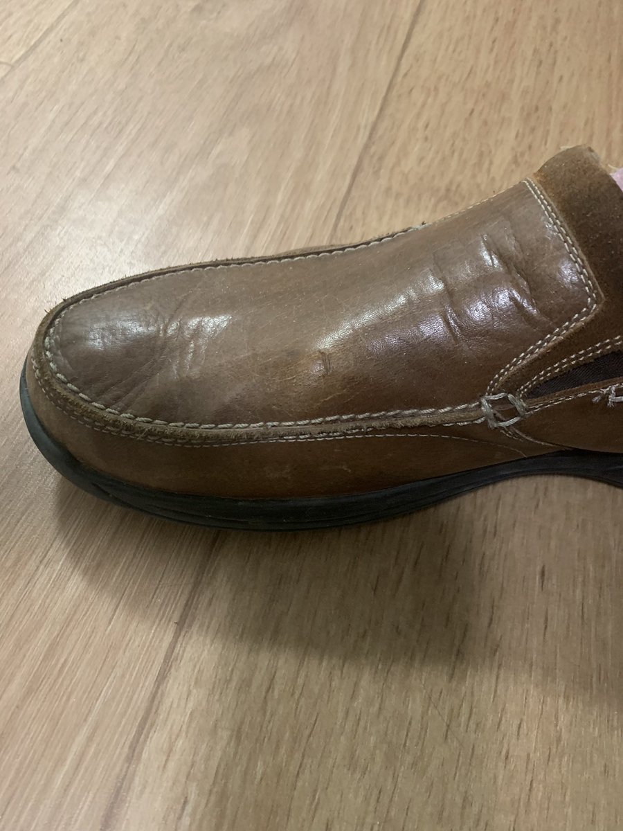 #Arthritis of the big toe joint  can present as a large and painful lump over the big toe. This not a true #bunion. You may not need an extensive surgery. Just a simple excision of the bump can reduce symptoms dramatically. #footsurgeon #anklesurgeon #pinakray #totalorthopaedics