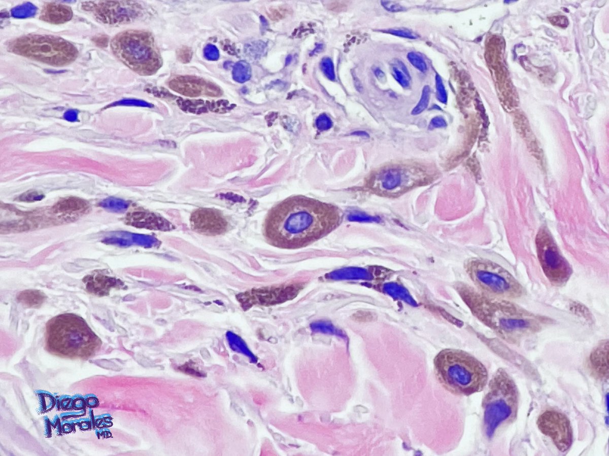 DiegoMoralesN's tweet photo. Epithelioid blue nevus. Some cells resemble avocados 🥑, plus the term “fried egg” is used way too much.

#dermpath #dermtwitter #PathTwitter #tooprettynottoshare #joyformorphology https://t.co/xIeZ57vIwS