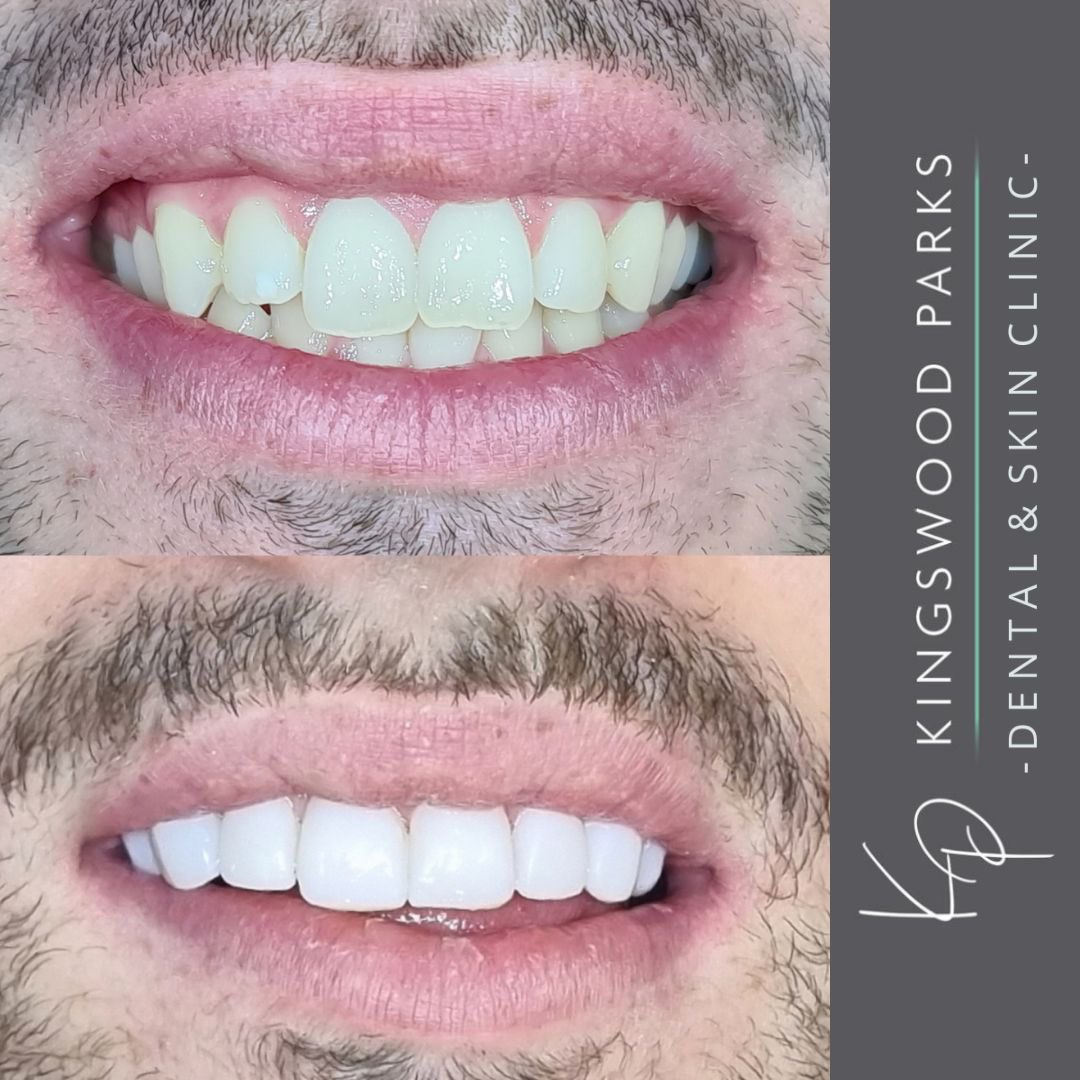 KPClinics's tweet photo. Composite Veneers x 8 

#dentalbonding #veneers #hull #hullcity https://t.co/MHIT9mO63W