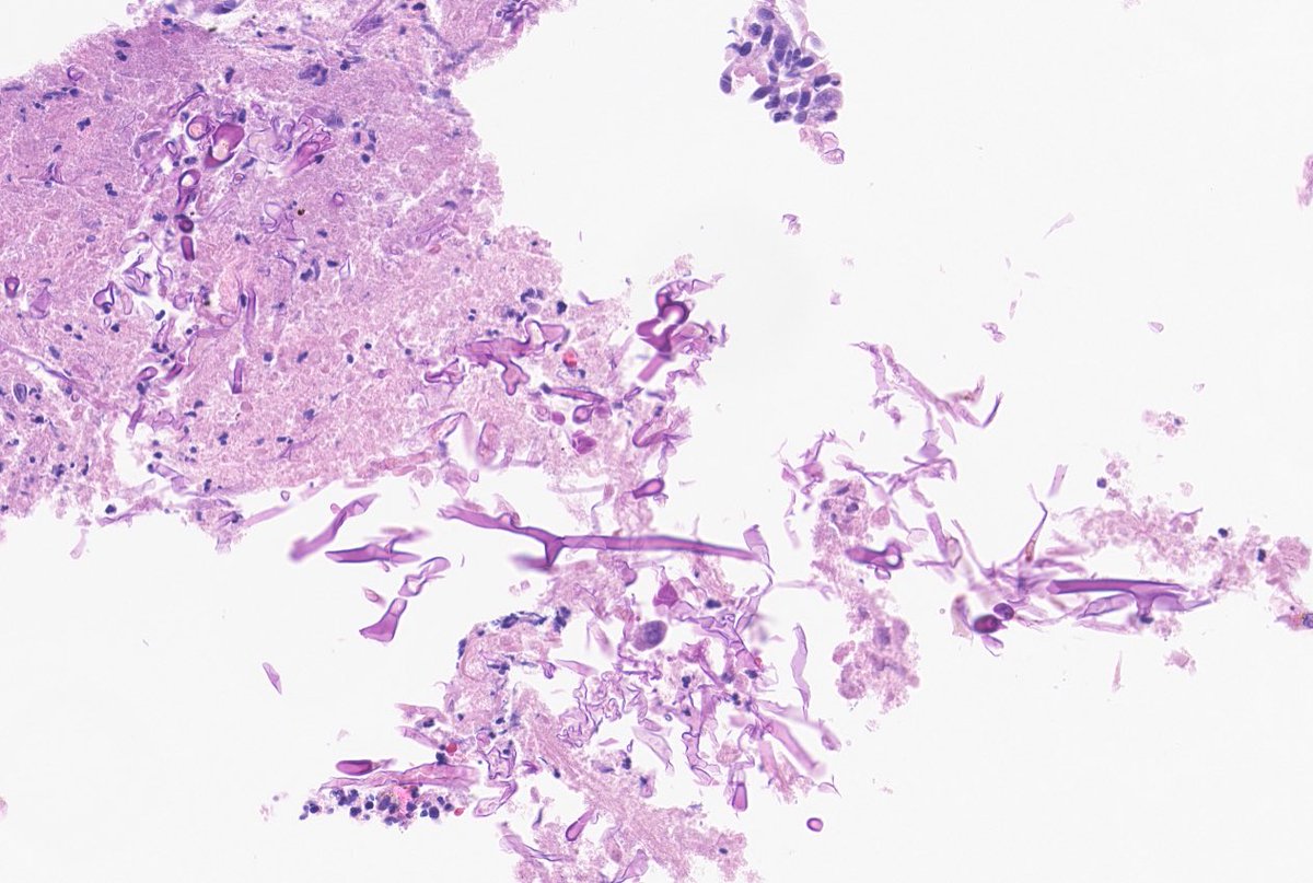 Mo_Alhamar's tweet photo. Pulmonary cavitary lesion bx showing mucormycosis (broad ribbonlike hyphae). H&amp;E and GMS stains #PulmPath #Pathboards #Pathology https://t.co/3XGpEcCcdg