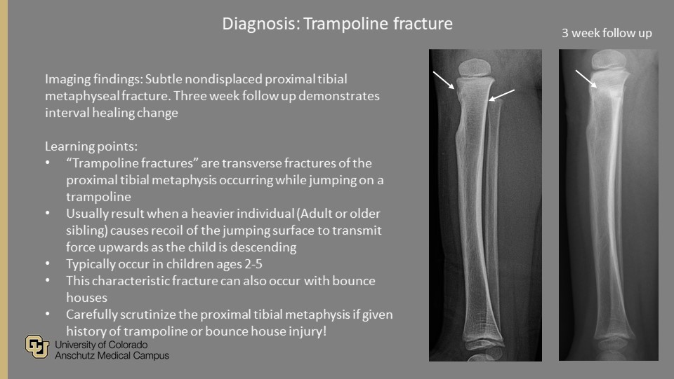 <a href="/PedsRadsColo/">CU Pediatric Radiology</a> Weekly #QualityRounds:

Toddler presents with leg pain after fall on trampoline

#ImagingOurFuture #PedsRad #MedEd #RadRes #FOAMrad #FOAMed #GoodCall #PeerLearning #RadTwitter

<a href="/COpediatricEM/">🏔COpediatricEM🚑</a> <a href="/SocPedRad/">The Society for Pediatric Radiology</a> <a href="/CURadiology/">CU Radiology</a> <a href="/curadresidents/">CU Radiology Residents</a>