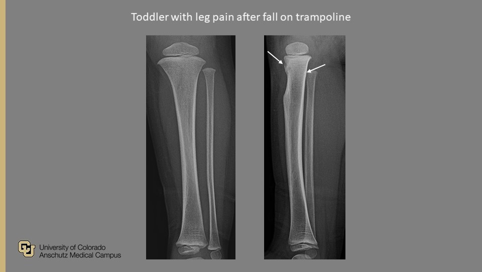 PedsRadsColo's tweet photo. @PedsRadsColo Weekly #QualityRounds:

Toddler presents with leg pain after fall on trampoline

#ImagingOurFuture #PedsRad #MedEd #RadRes #FOAMrad #FOAMed #GoodCall #PeerLearning #RadTwitter

@COpediatricEM @SocPedRad @CURadiology @curadresidents https://t.co/7d75ygGqA6