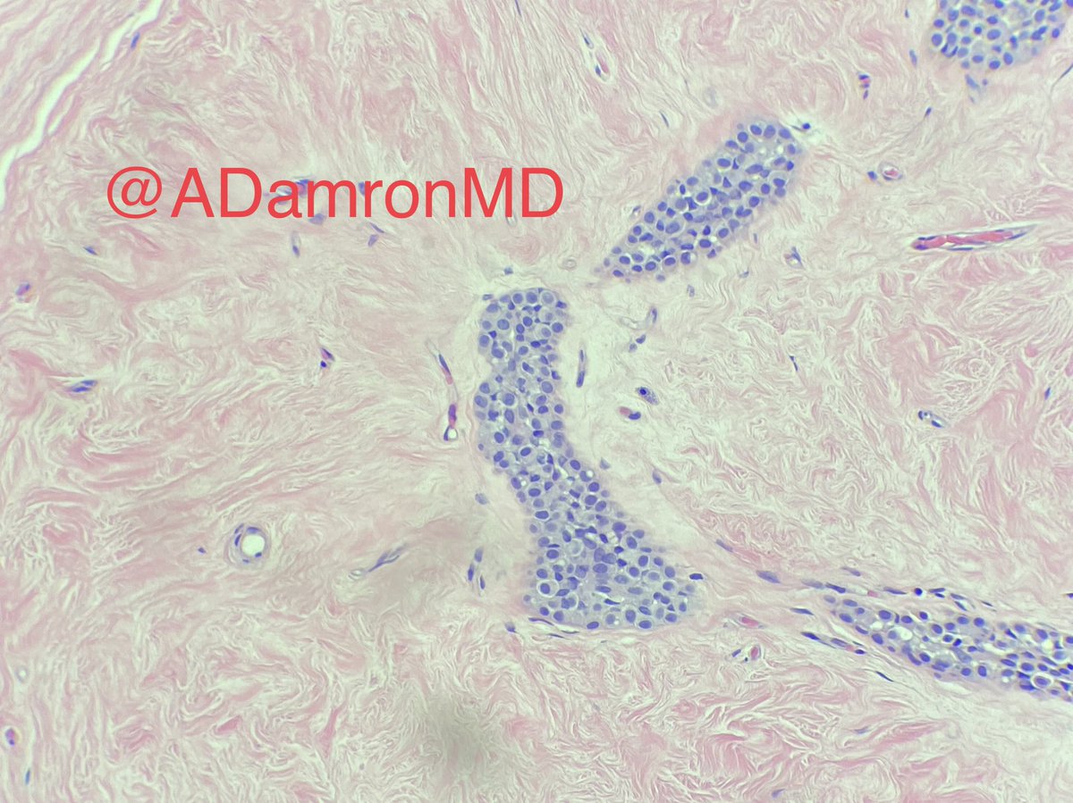 Alexander Damron, MD (@adamronmd) on Twitter photo Ok #pathresidents here is some classic #breastpath for you! 75 yo F with calcifications show a hyalinized fibroadenoma with calcifications BUT what else do you see?? <a href="/BCM_PathRes/">BCM_PathRes</a> <a href="/PennPathLabMed/">Penn Path & Lab Medicine</a> <a href="/loyolapathology/">Loyola Pathology & Laboratory Medicine</a> @path_nat <a href="/PatMcIntireMD/">Patrick J. McIntire</a> <a href="/LizaMQuintana/">Liza Quintana, MD</a> <a href="/jennpincus/">Jenny Pincus, MD</a> Ok #pathresidents here is some classic #breastpath for you! 75 yo F with calcifications show a hyalinized fibroadenoma with calcifications BUT what else do you see?? <a href="/BCM_PathRes/">BCM_PathRes</a> <a href="/PennPathLabMed/">Penn Path & Lab Medicine</a> <a href="/loyolapathology/">Loyola Pathology & Laboratory Medicine</a> @path_nat <a href="/PatMcIntireMD/">Patrick J. McIntire</a> <a href="/LizaMQuintana/">Liza Quintana, MD</a> <a href="/jennpincus/">Jenny Pincus, MD</a>