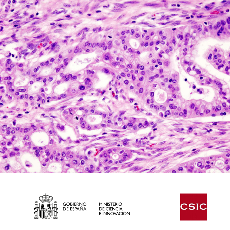 CienciaGob's tweet photo. Un estudio coliderado por el @CSIC identifica un nuevo biomarcador de diagnóstico precoz para el cáncer de páncreas.

Los investigadores asocian la presencia de la proteína AXL a la detección de este tipo de tumores, la tercera causa de muerte por cáncer en países desarrollados.