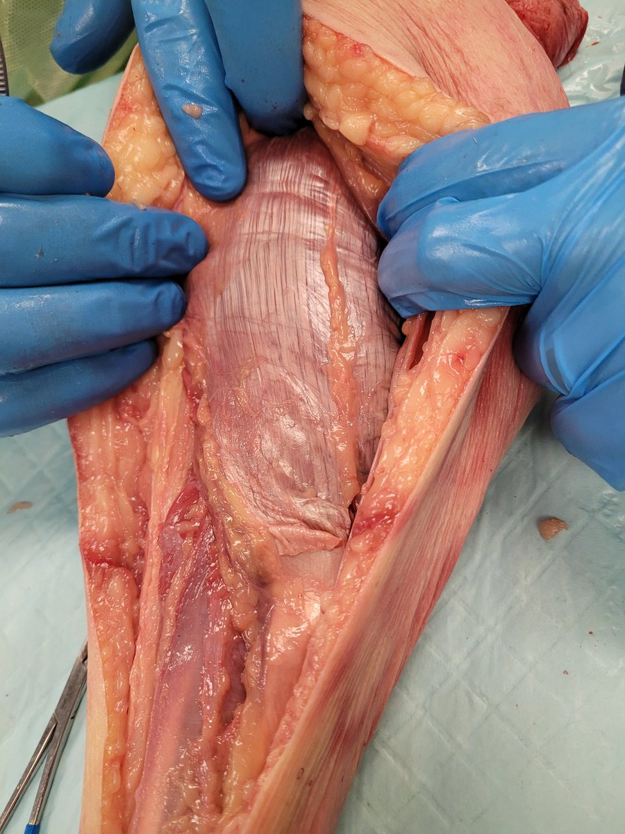 DpmNaren's tweet photo. It was great to learn and teach #podiatry residents at @Intermountain in Salt Lake City today! We went over several lower extremity flaps. Here's to future of podiatry! #woundcare #surgery #actagainstamputation #limbsalvage @ArizonaPodiatry https://t.co/eSIrazXXGf