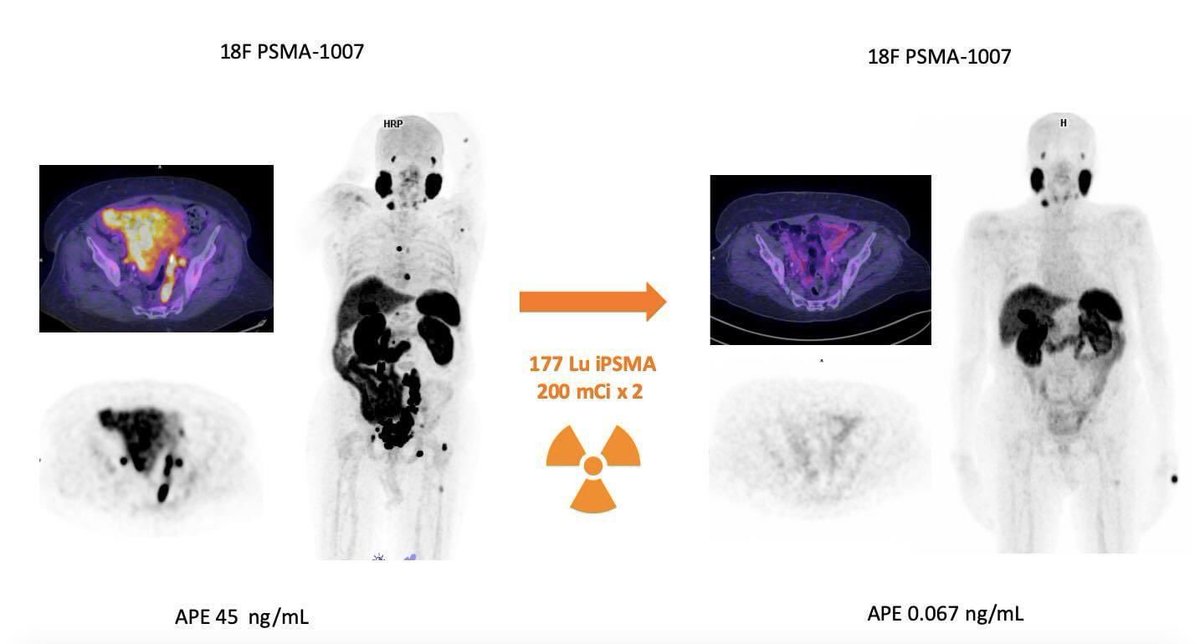 Gran respuesta después de solo 2 dosis de 177Lu iPSMA (200 mCi x 2) disminuyendo el 96,5 % de la carga tumoral metabólica. 🇲🇽 #INCan #nucelarmedicine #theranostics