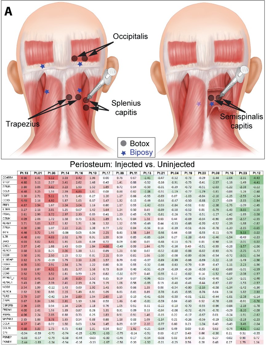 Gfrerer et al. shed new light on how onabotulinumtoxinA helps prevent occipital headache and neck pain. bit.ly/3zhxDnf