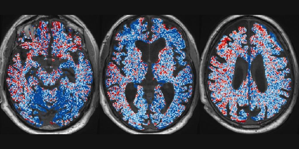 Parker et al. show that cortical spreading depolarization, blood-brain barrier dysfunction, and pro-inflammatory TGF β signalling are associated with severe outcomes following repetitive mild TBI. bit.ly/3EEGzEk