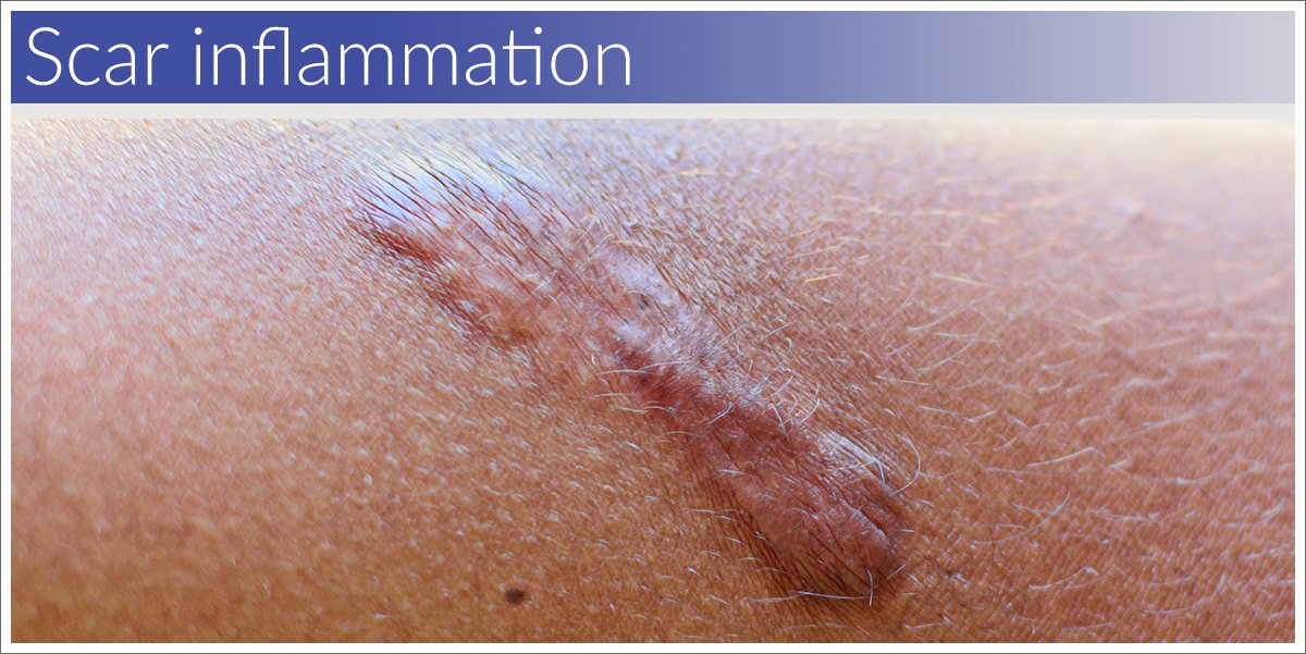 Research suggests that scar formation and bodily inflammation are directly correlated to one another.

full article: bit.ly/3G9mBSW

#scar #inflammation #silicone #gel #biodermis