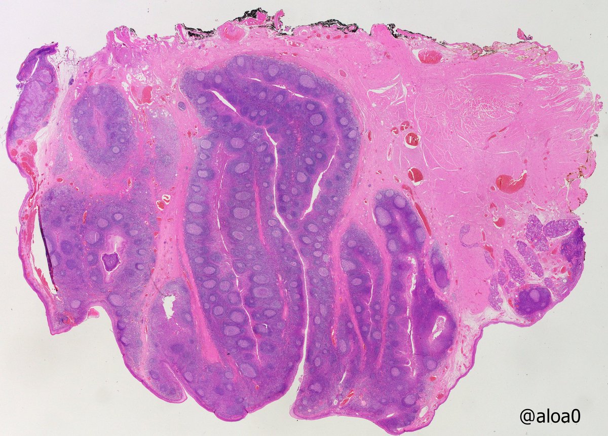 aloa0's tweet photo. Tiny HPV-positive SCC  in tonsil (3mm) with a large metastatic level II LN (3 cm). #ENTpath #Headandneckpath #HNpath https://t.co/GfIJS3AZ1y