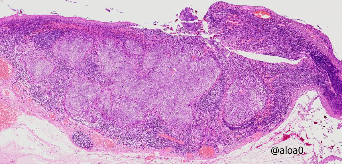 aloa0's tweet photo. Tiny HPV-positive SCC  in tonsil (3mm) with a large metastatic level II LN (3 cm). #ENTpath #Headandneckpath #HNpath https://t.co/GfIJS3AZ1y