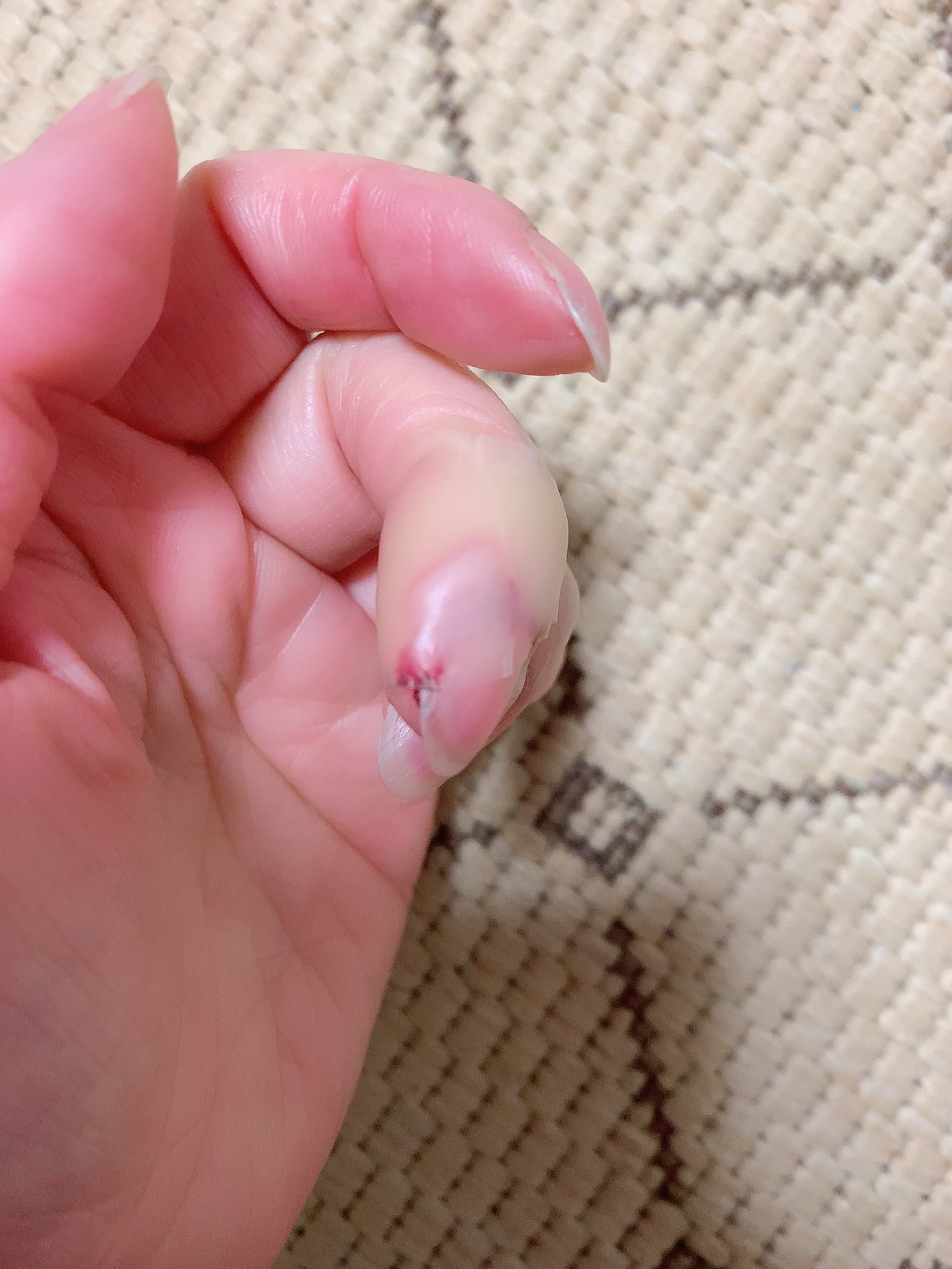 茜雲 私はピーラーで同じ状態になり 手を洗うにも爪が剥がれそうで整形外科に行きましたよ お大事にしてくださいね Twitter