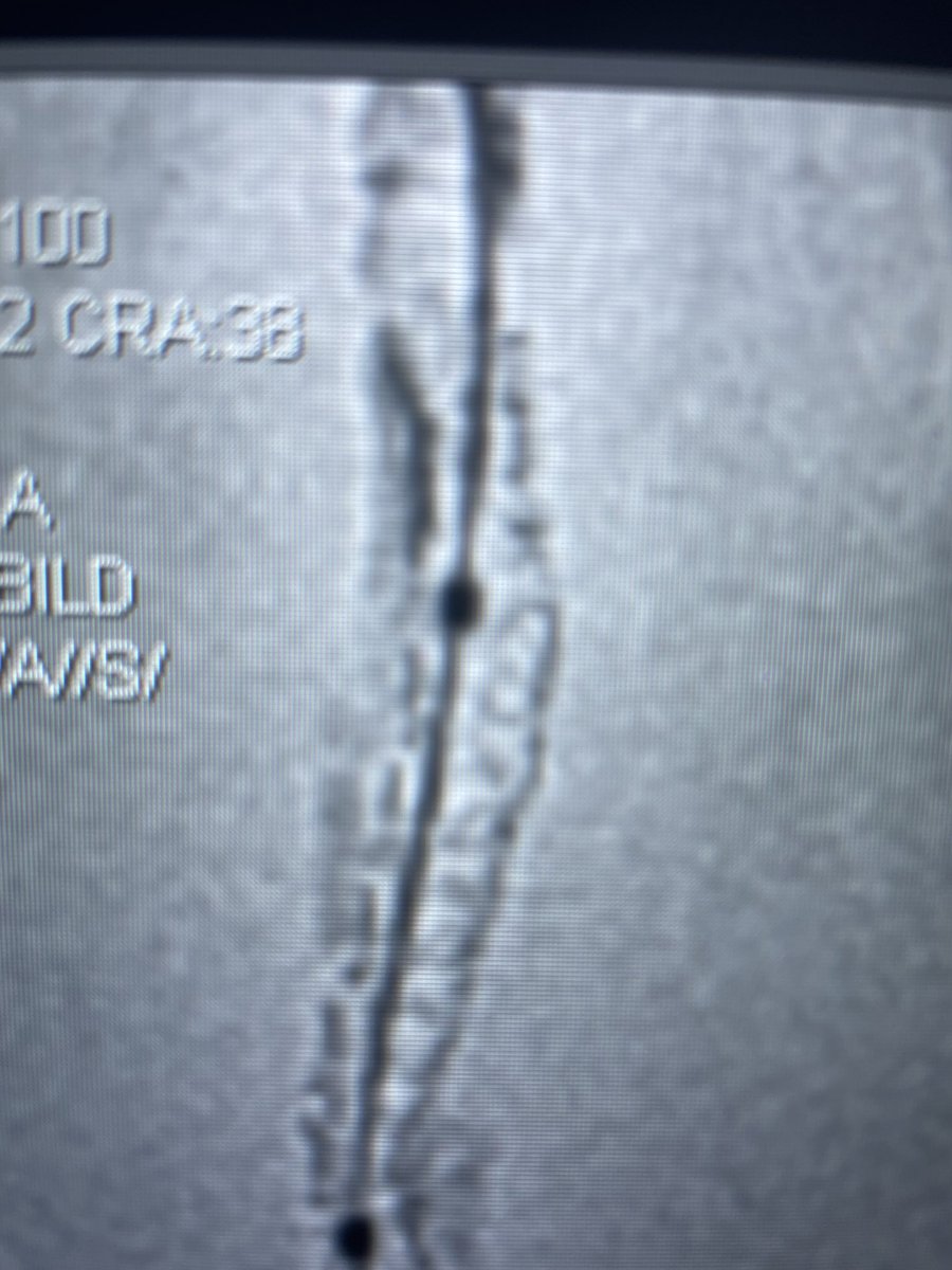 HolgerNef's tweet photo. Now live at ⚠️https://t.co/xdvRupBVLn⚠️ Coronary complications….chaired by @tommasoggori #rmht #ukgm #pci @dscharpfMD @BayerMatthias @BauerTimm @oliver_dorr https://t.co/esproGG5mz