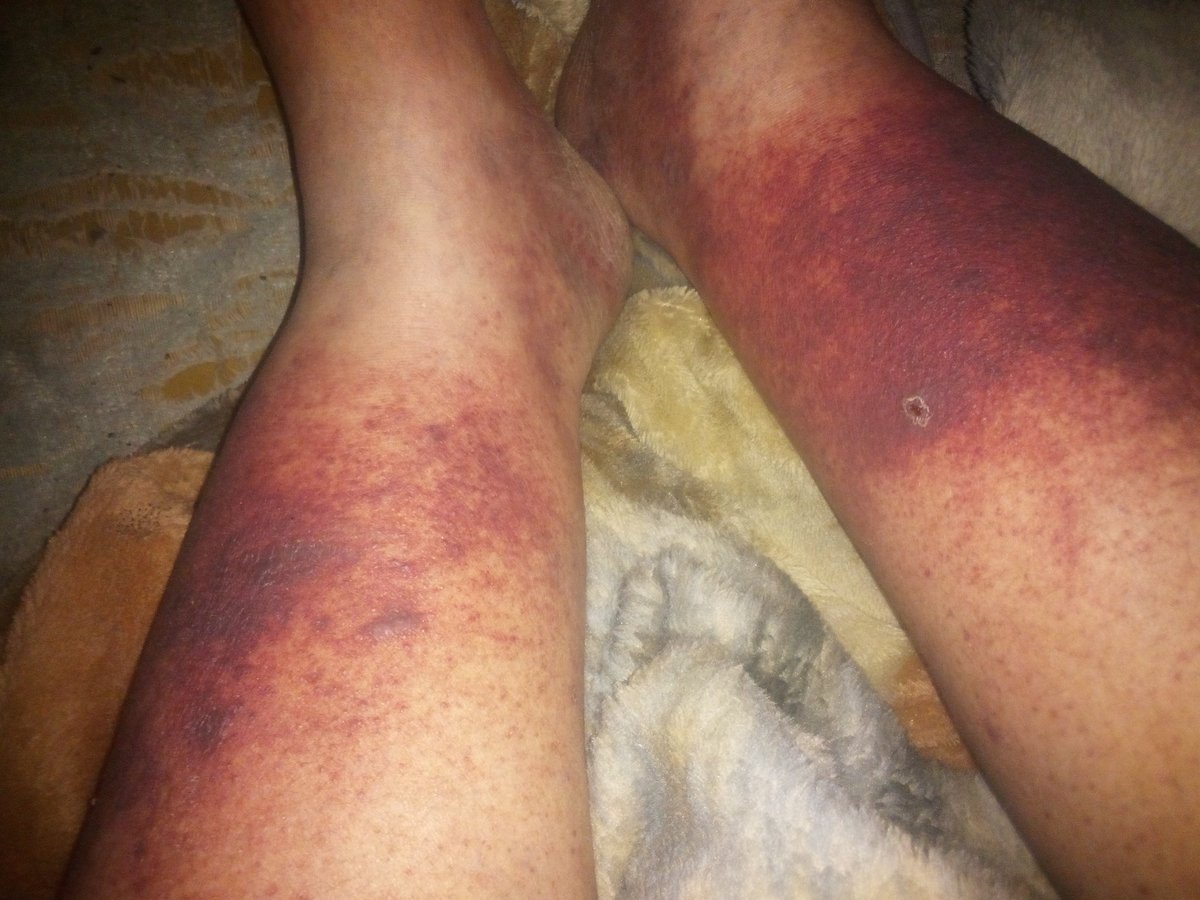 DocHollidead's tweet photo. Something's gotta fukkin give my legs hurt so fukkin bad someone shoot me already https://t.co/RVZZoICsGl