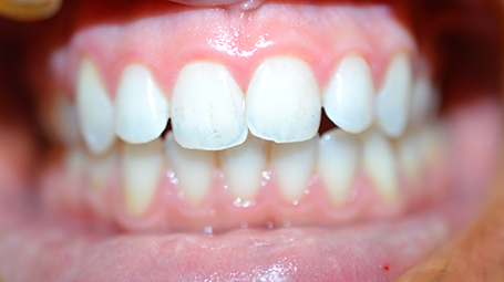 Our orthodontic gallery  shows a range of treatments, before and after. bit.ly/2rPU56c