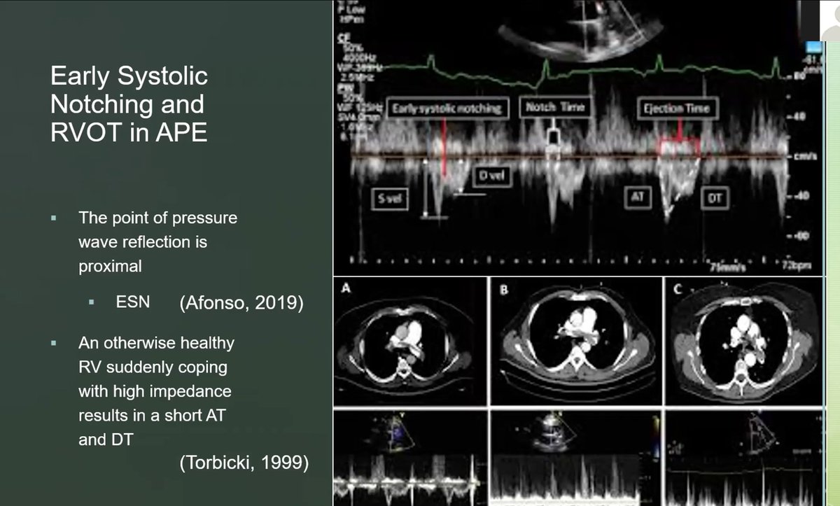 Just had the best RVOT (Right Ventricular Outflow Tract) Doppler lecture ever by <a href="/khaycock2/">korbinhaycockmd</a> at our fellows conference! Watch the video below 👇
youtu.be/vF3wQYSAuE0

This will seriously🤯 your mind!

Thanks <a href="/khaycock2/">korbinhaycockmd</a>, it's always an honor!

🔗👉youtu.be/vF3wQYSAuE0