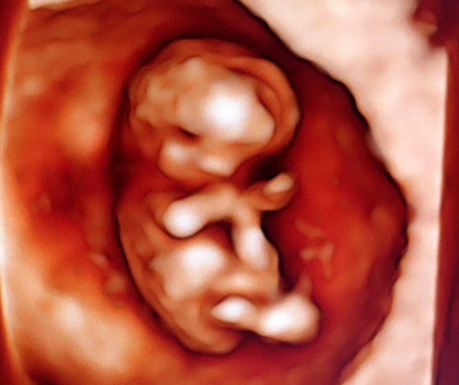 fetal_uk's tweet image. This baby is only 10 weeks old🤩

At 10 weeks old, baby is roughly the size of a strawberry 🍓

Yet, you can already clearly see the shape of their tiny body as it forms. Isn't that incredible? 

#10weekspregnant #3Dbabyscan #4Dbabyscan #earlypregnancyscan #fetalmedicineuk