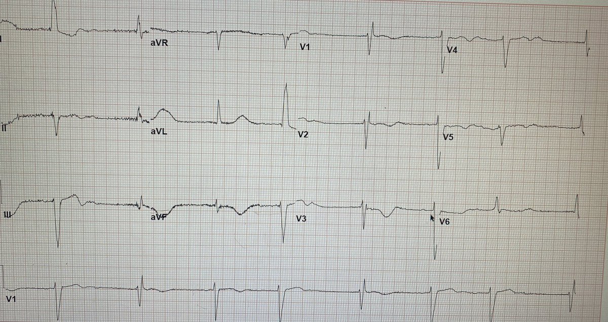ED_MunozMD's tweet photo. 91 y/o 👵 with Parox AF admitted with lightheadedness. Chronic LBBB since 2017. Below 1) ECG on presentation 2) repeat ECG 3) baseline. What are your thoughts? @syamkumarmd @ecgrhythms @MaruanCarlos @UlhasDr @ECGcases https://t.co/s9f6JLUxNq