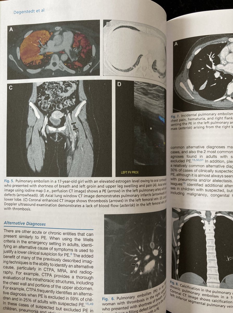 Proud of <a href="/SpenceDeg/">Spencer Degerstedt, MD</a> for somehow writing his first, first author paper on paediatric PE during his stint at <a href="/BostonChildrens/">Boston Children's</a>. I don’t understand any of it, but the colour printing is 100% very nice 🧡❤️💛💚💜
