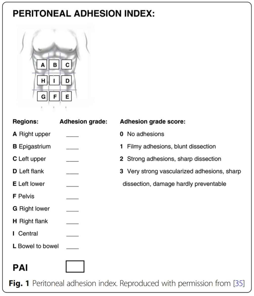 DRAFTABAHMED7's tweet photo. 2/2 🅐︎ Algorithm to diagnosis and treatment of ASBO (Adhesive small bowel obstruction), 🅑︎ Zuhulke Histological classification of adhesions. 🅒︎ Nair adhesion scoring system. 🅓︎ Peritoneal  adhesion index
#intestinalobstruction 
#exploratorylaparotomy 
#adhesions https://t.co/wL9ShLl2MW